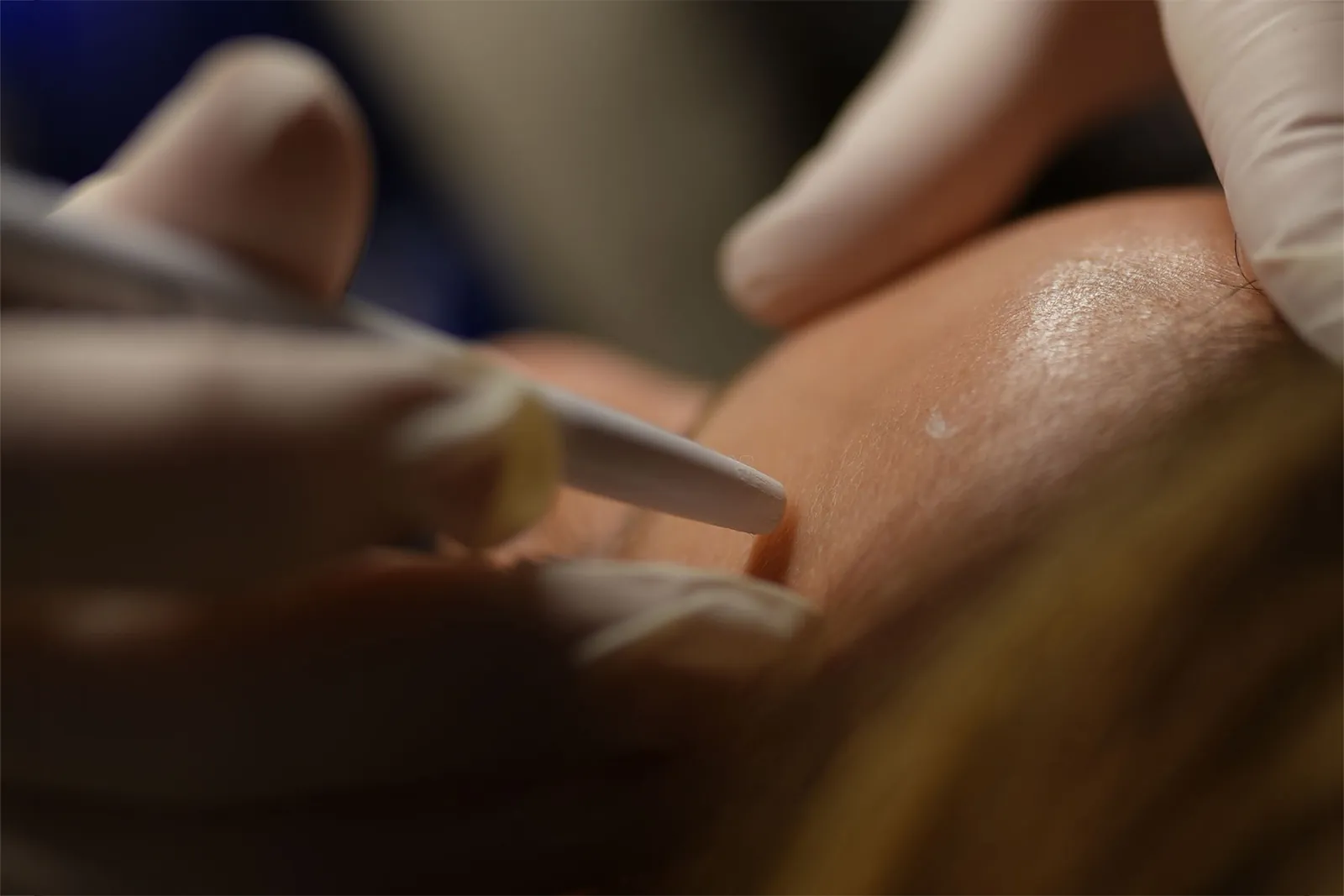 Microneedling