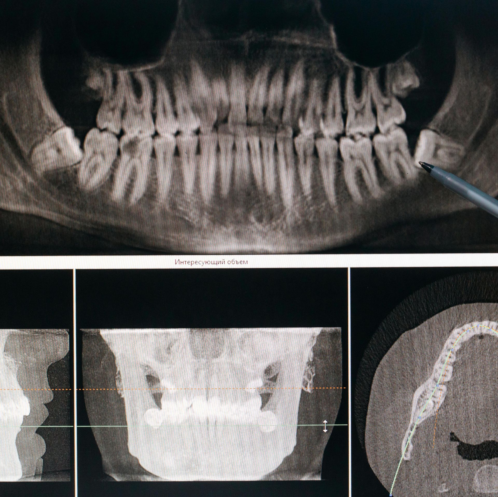 Composite dental X-ray images showing panoramic and sectional views of teeth and jaw. A pen points to an impacted lower wisdom tooth on the right side.