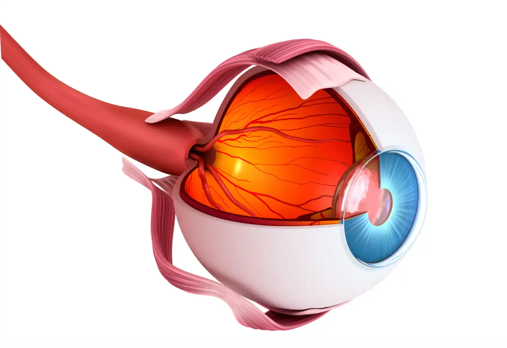 Optic Nerve Atrophy