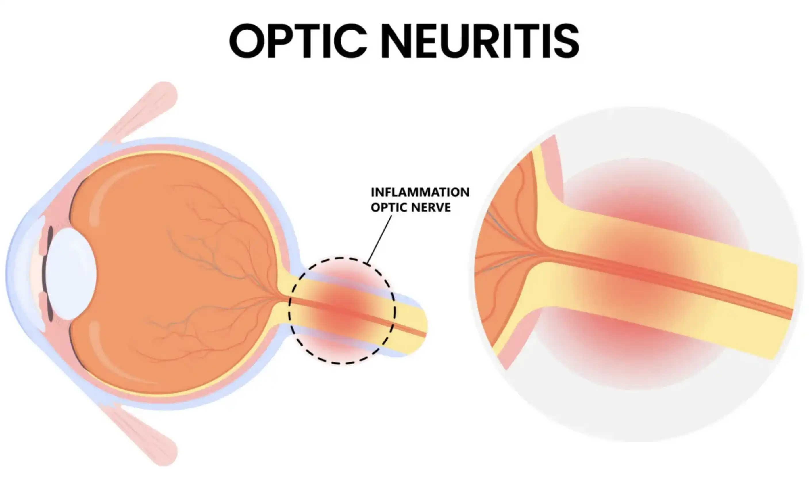 Optic Neuritis