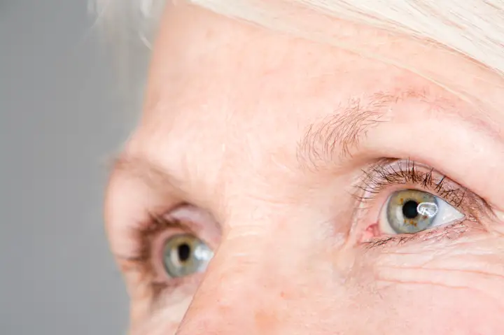 Macular Telangiectasia