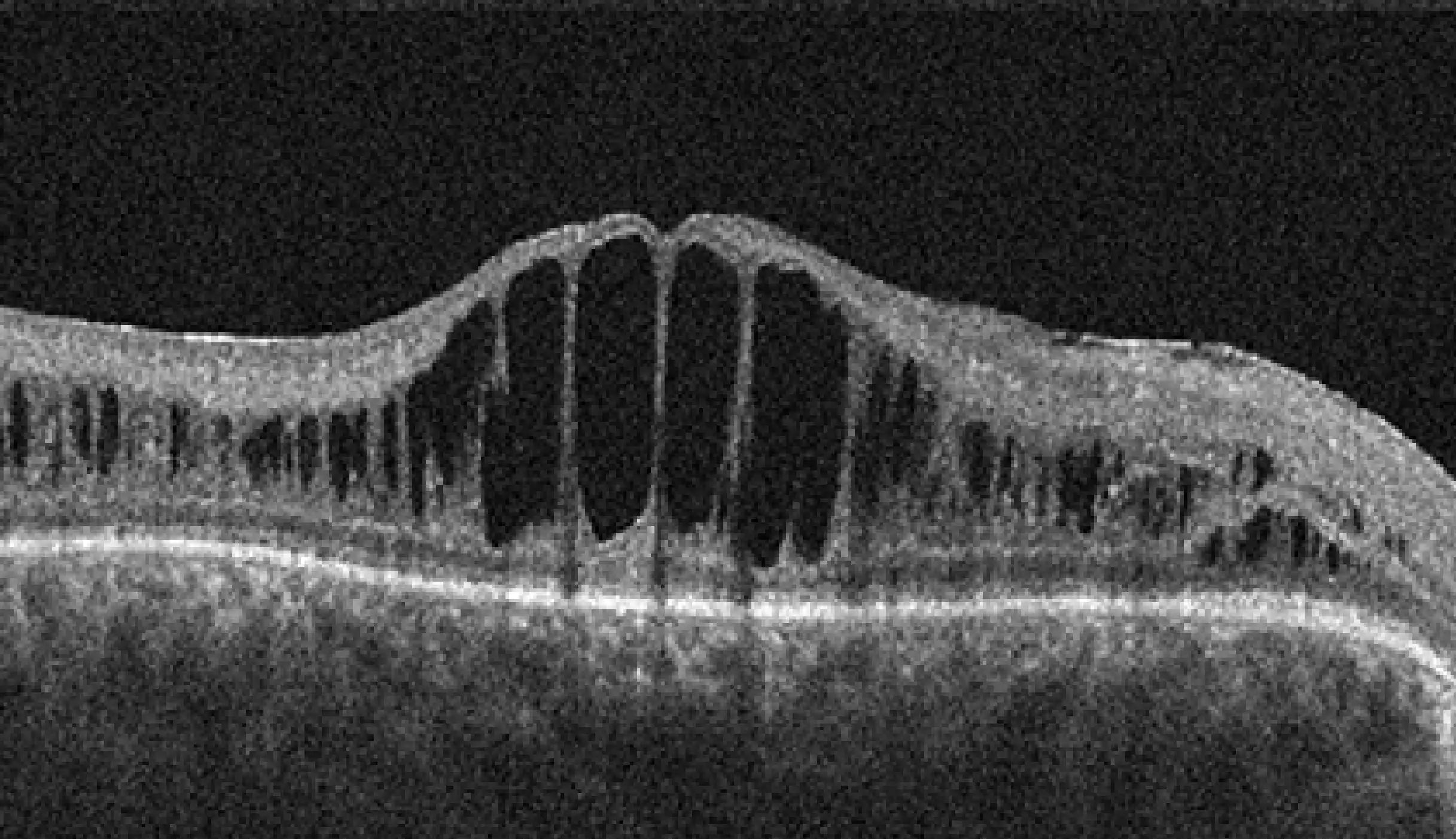 Retinoschisis