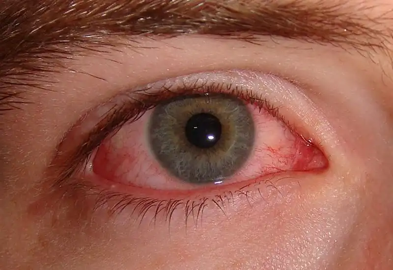 Sjogren's Syndrome