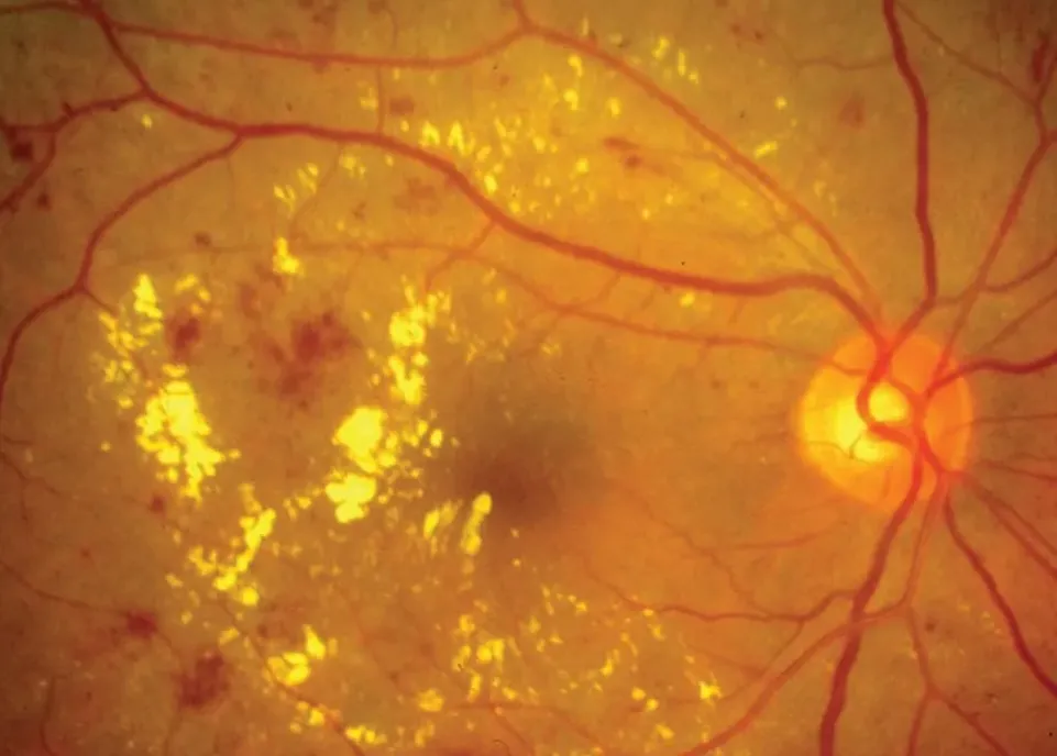 Diabetic Macular Edema (DME)