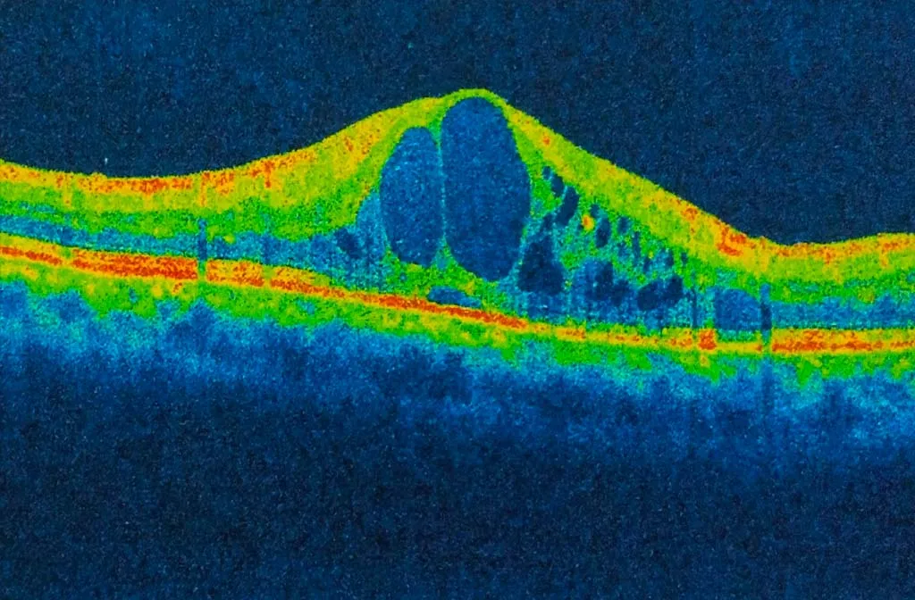 Cystoid Macular Edema (CME)
