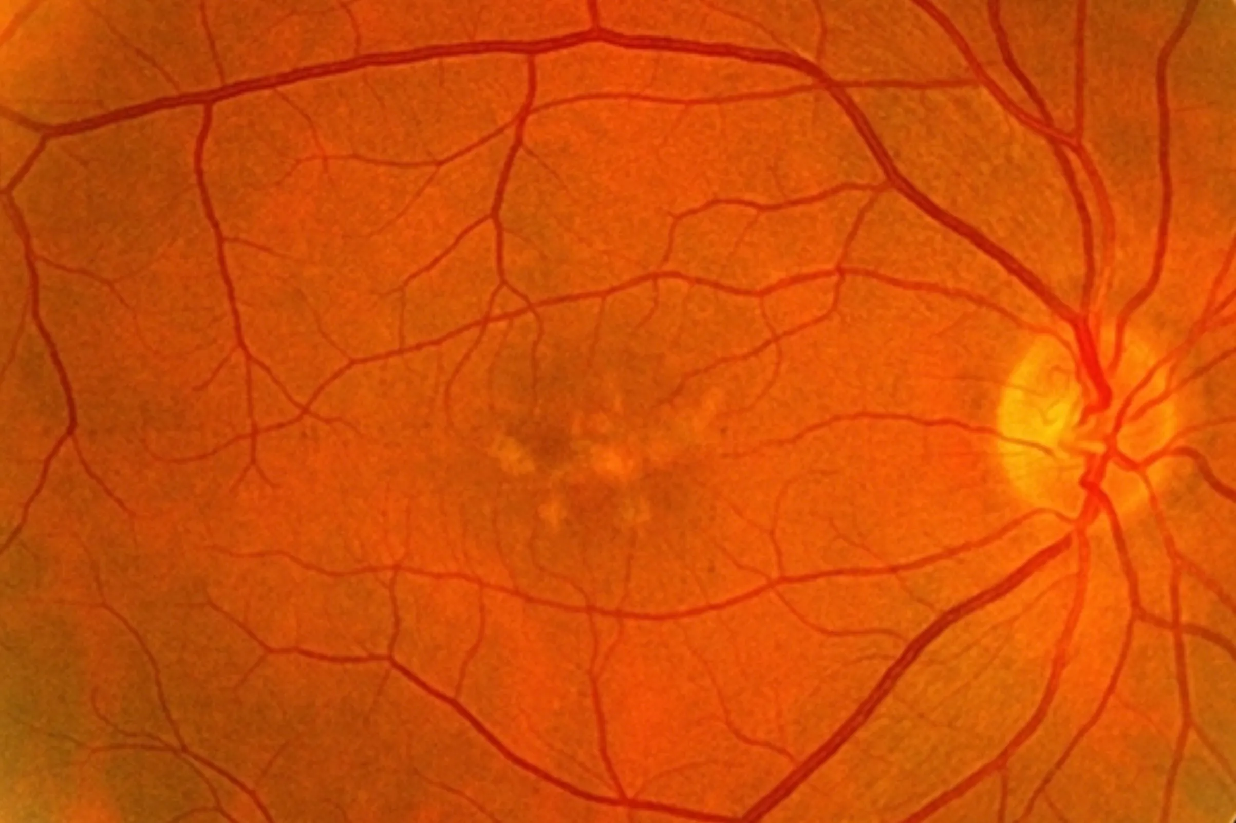 Pattern Dystrophy
