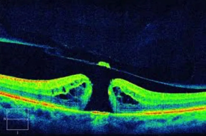 Macular Hole