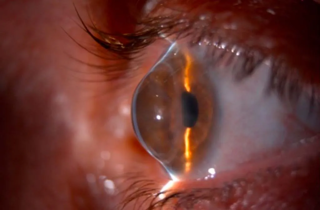 Corneal Ectasia