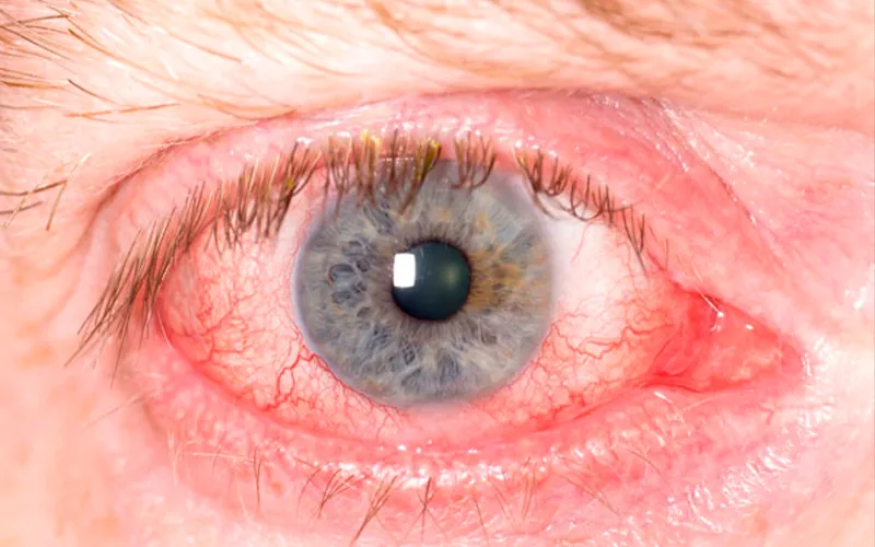 Choroiditis