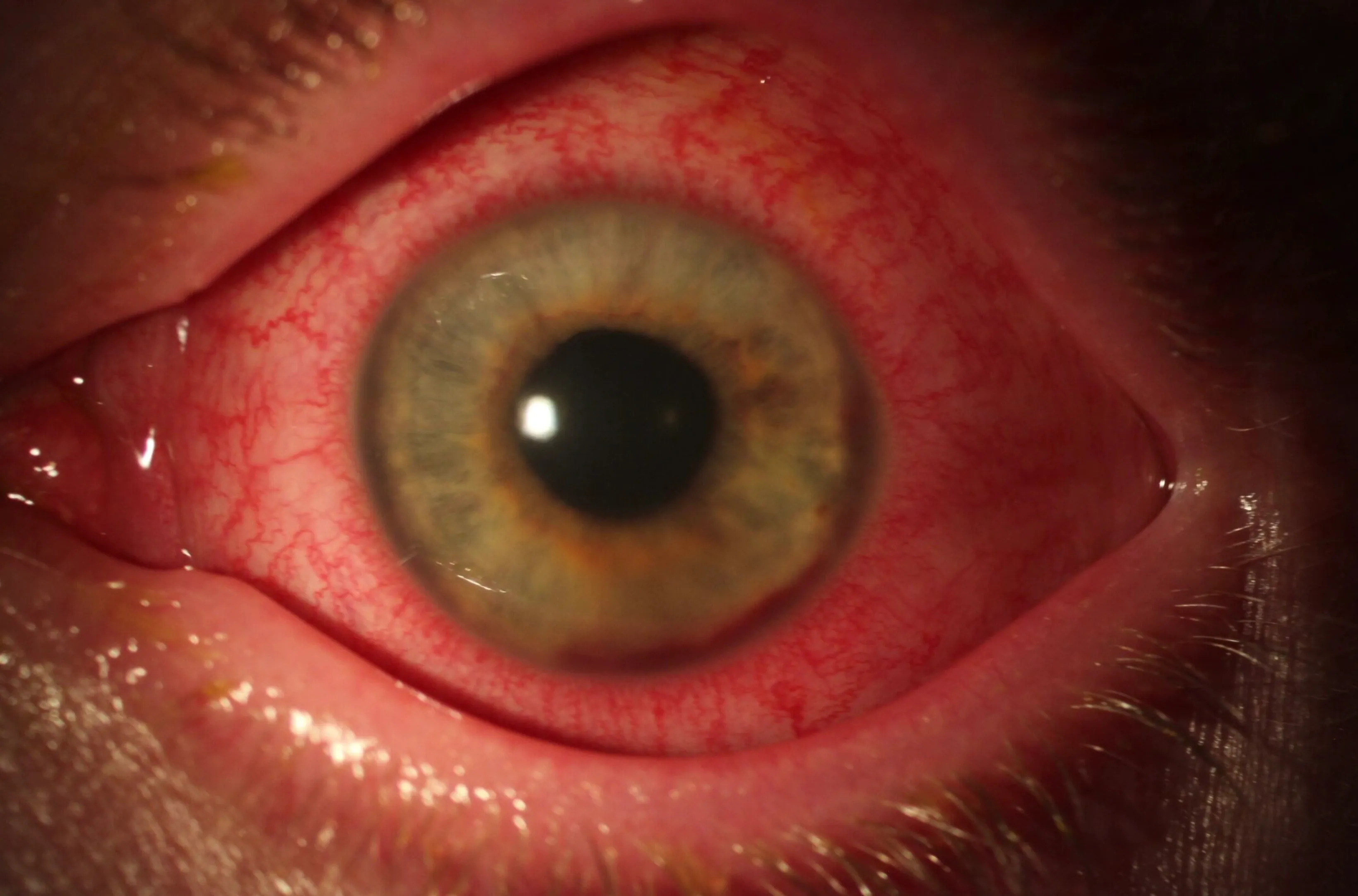 Panuveitis