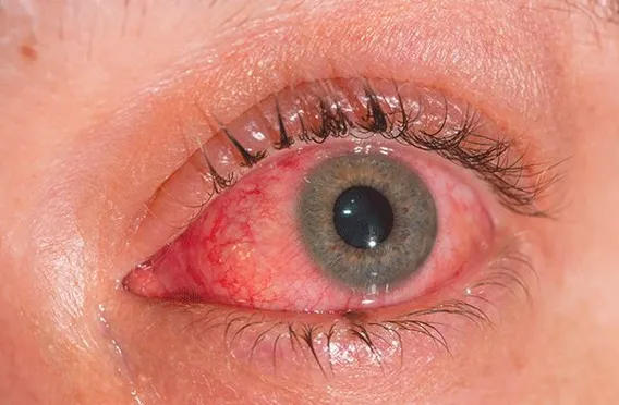 Retinal Vasculitis