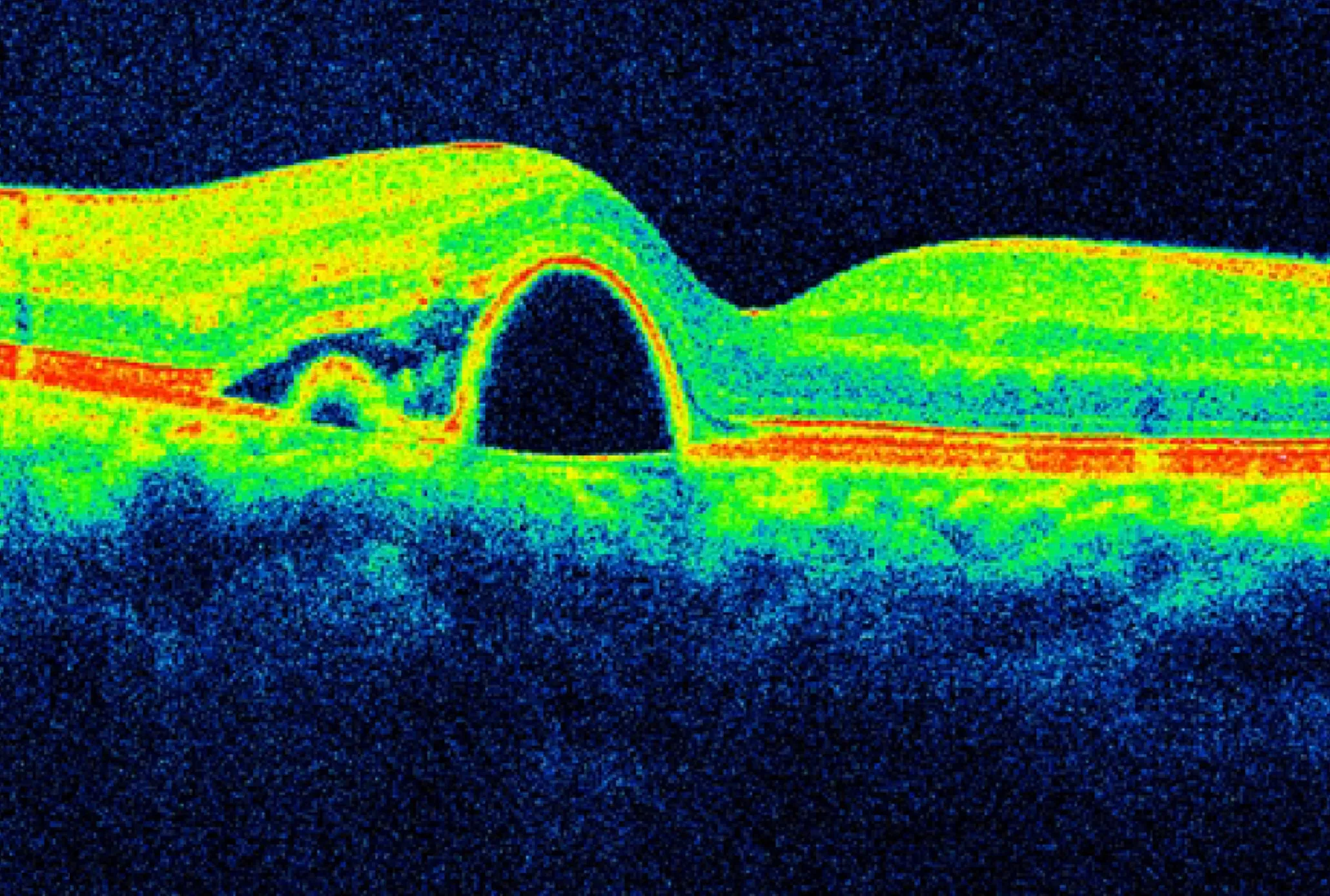Polypoidal Choroidal Vasculopathy