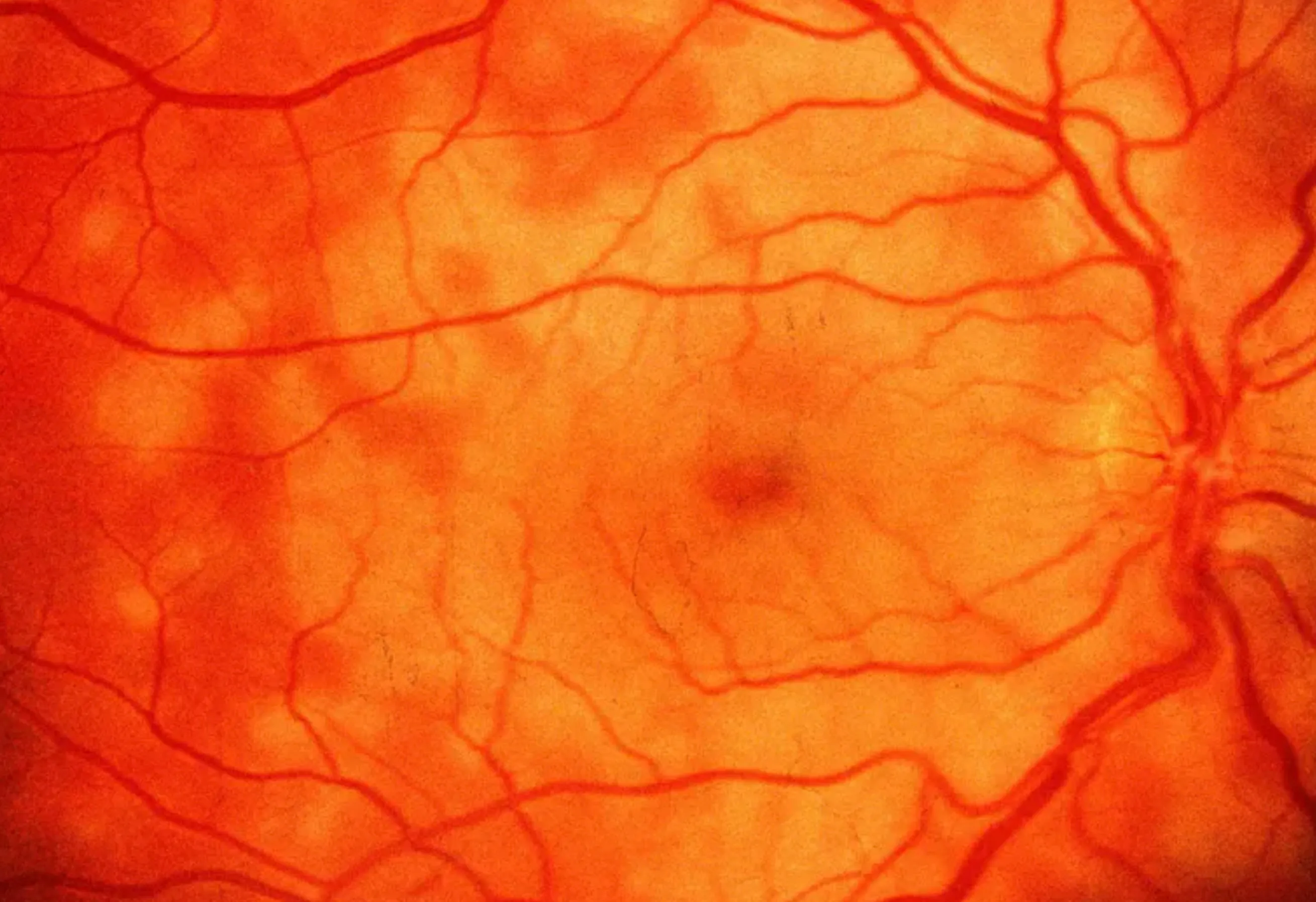 APMPPE (Acute Posterior Multifocal Placoid Pigment Epitheliopathy)