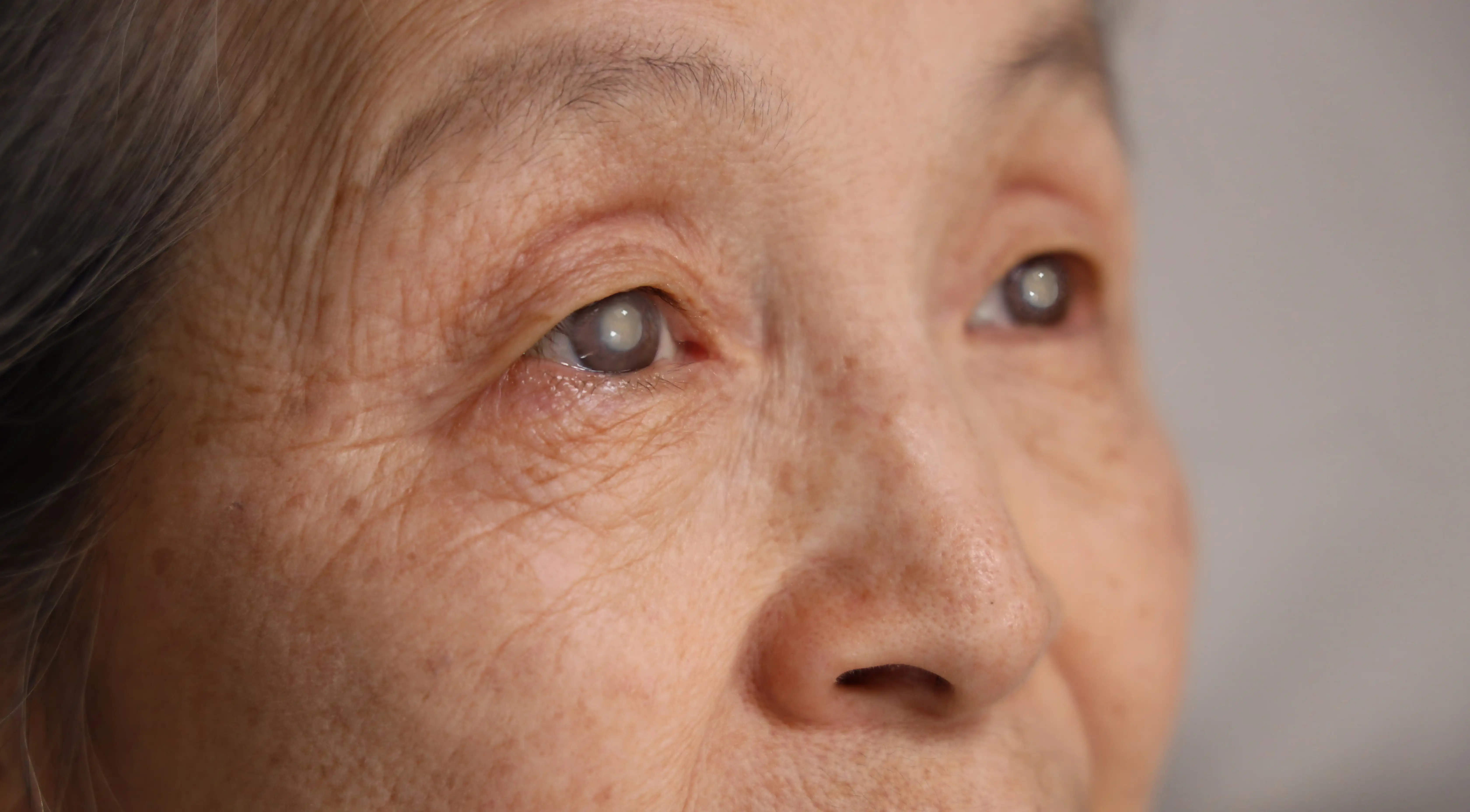 Cataract Surgery With Glaucoma: Eye Pressure, Lens Choice, MIGS and Recovery