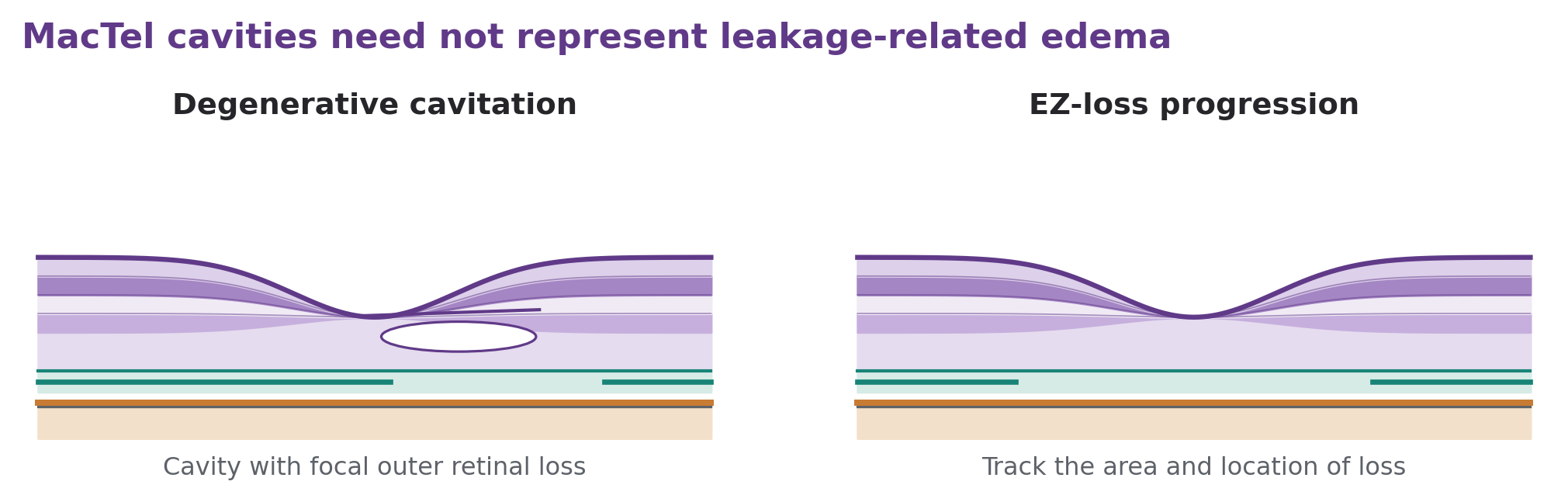 A MacTel cavity with an ILM drape and focal EZ loss is paired with a wider interruption of the photoreceptor-associated band.