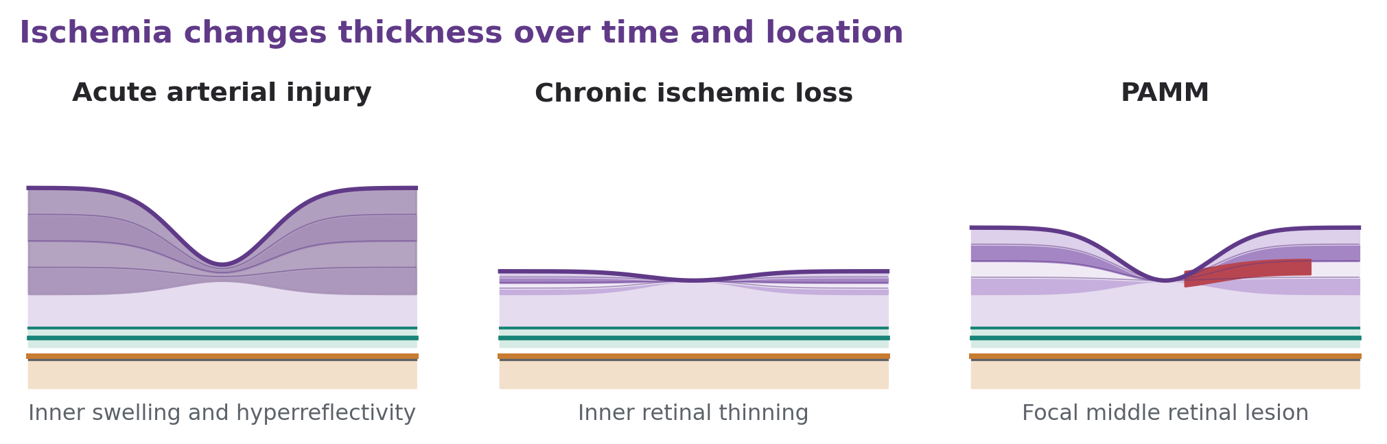Acute inner retinal swelling, chronic inner retinal thinning, and a focal middle retinal ischemic band are compared.