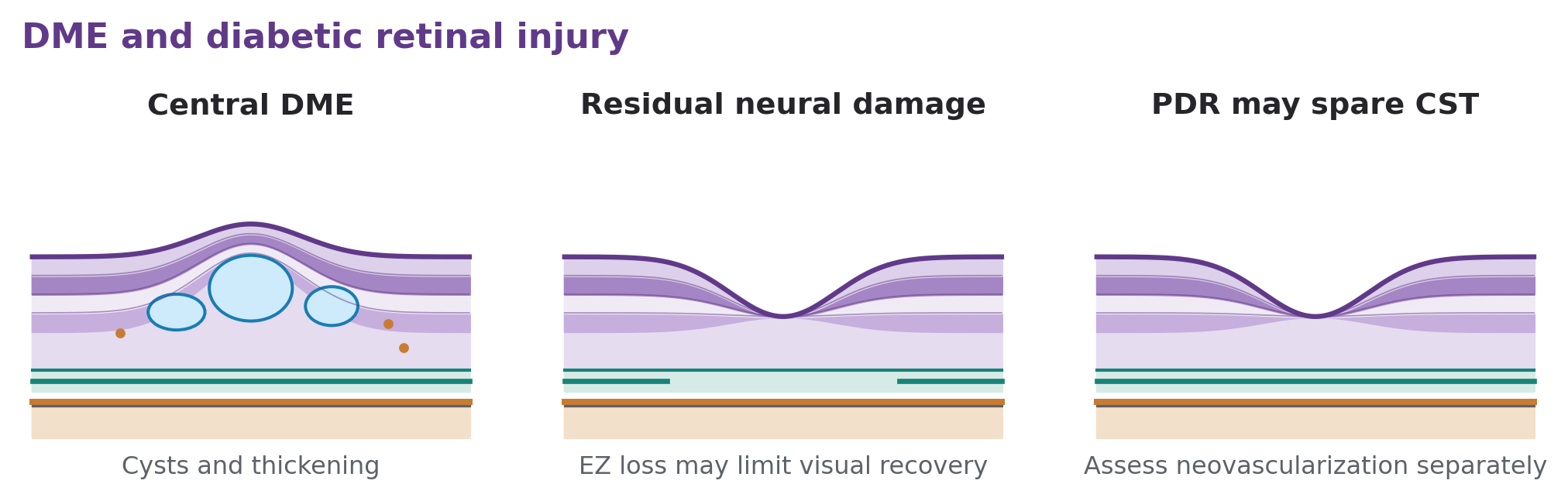 Panels show DME cysts, a relatively dry retina with damaged ellipsoid zone, and a central section that cannot exclude peripheral PDR.