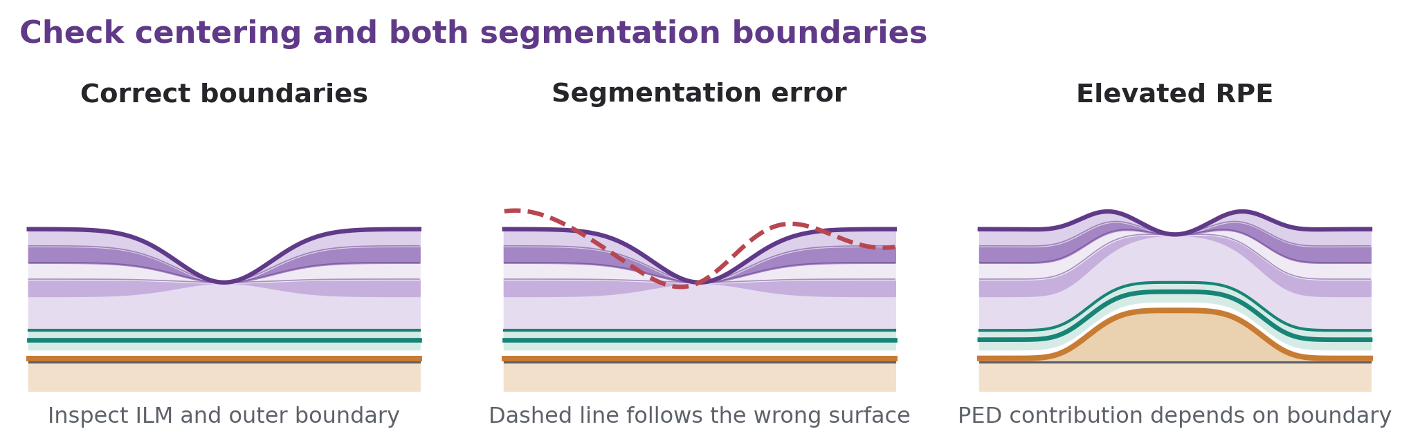 Three retinal sections show correct segmentation, a false upper segmentation line, and an elevated RPE contour.