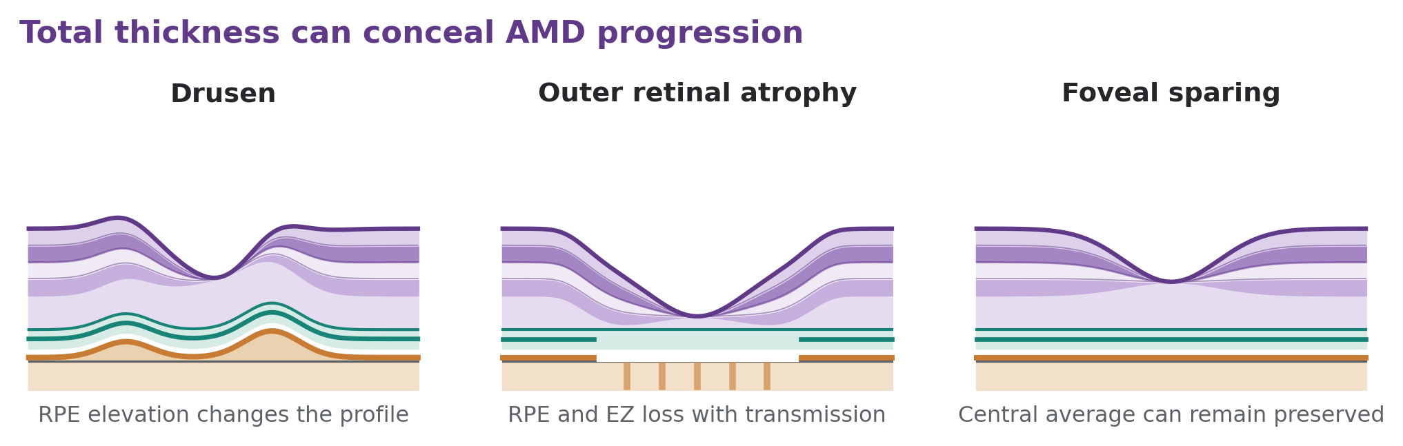Sketches of drusen, central outer retinal and RPE atrophy, and a preserved foveal section despite possible extracentral atrophy.
