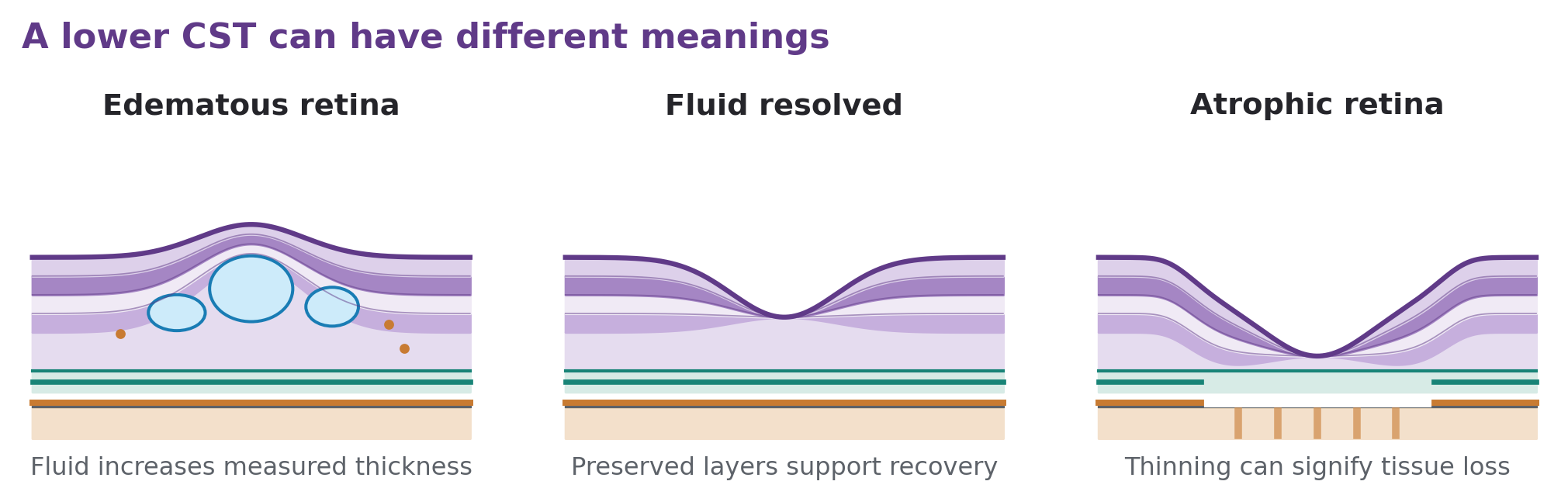 Retinal sketches compare fluid-related swelling, a preserved retina after resolution, and a thin atrophic retina.