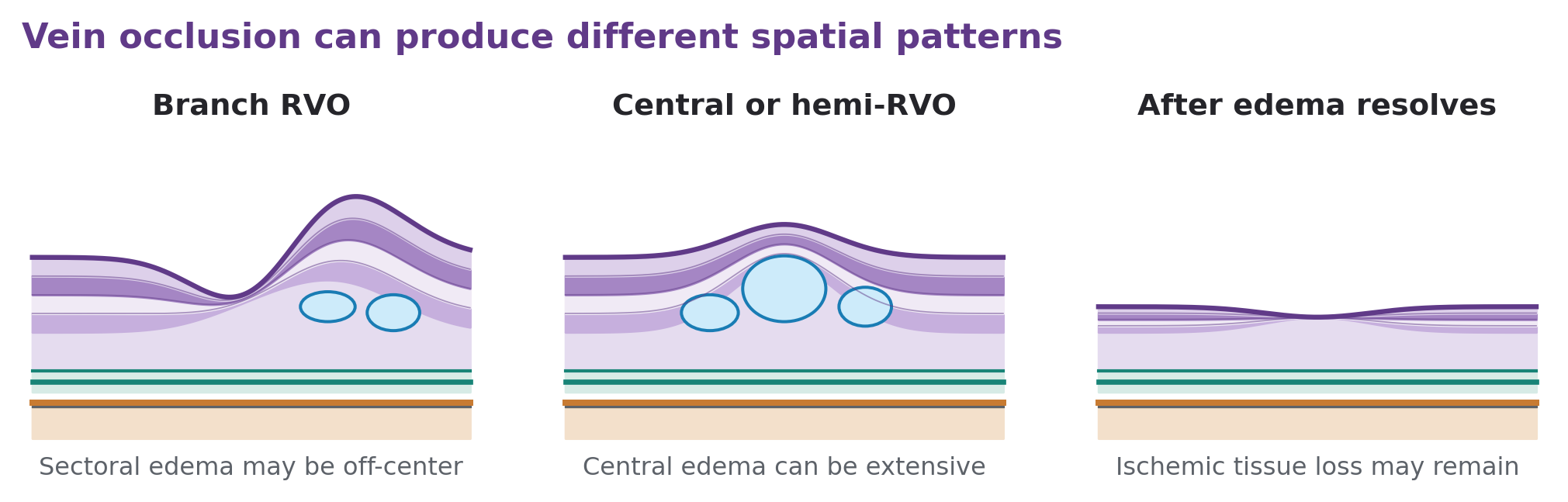 Schematic sections show sectoral edema, diffuse central cystic edema, and inner retinal thinning after ischemic injury.