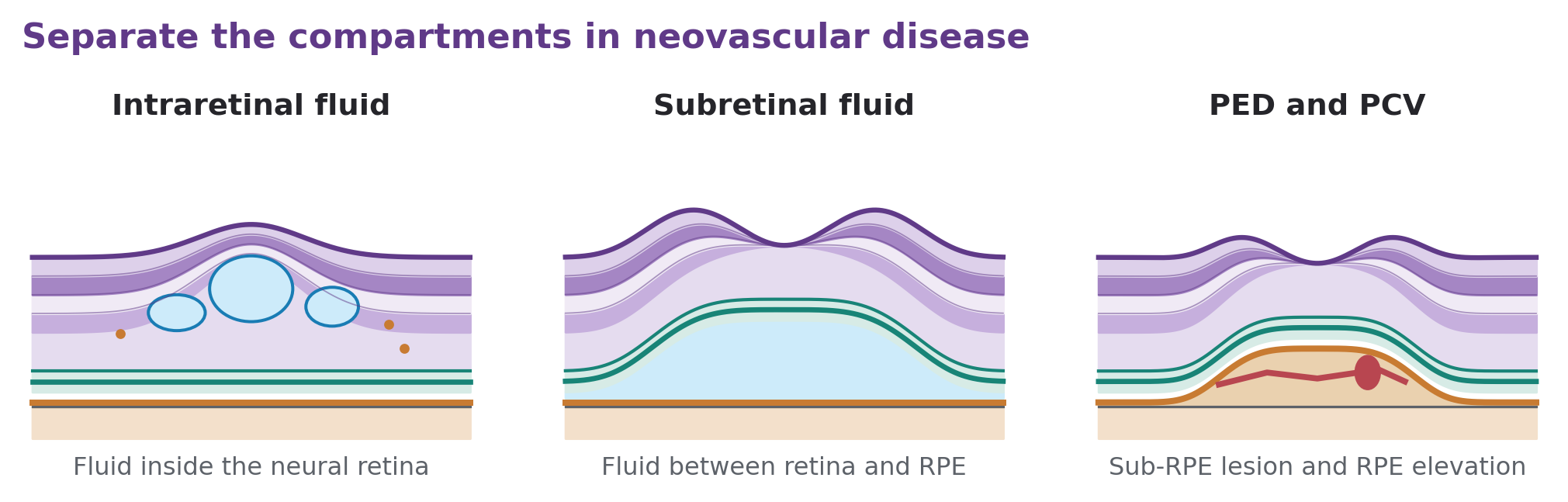 Three sections identify intraretinal cysts, subretinal fluid, and a pigment epithelial detachment with a schematic PCV lesion.