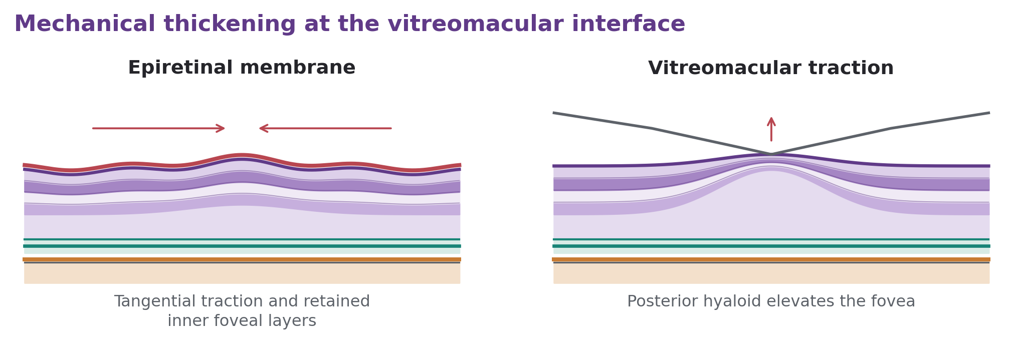 An epiretinal membrane with inward tangential arrows is paired with vitreomacular traction elevating the central fovea.