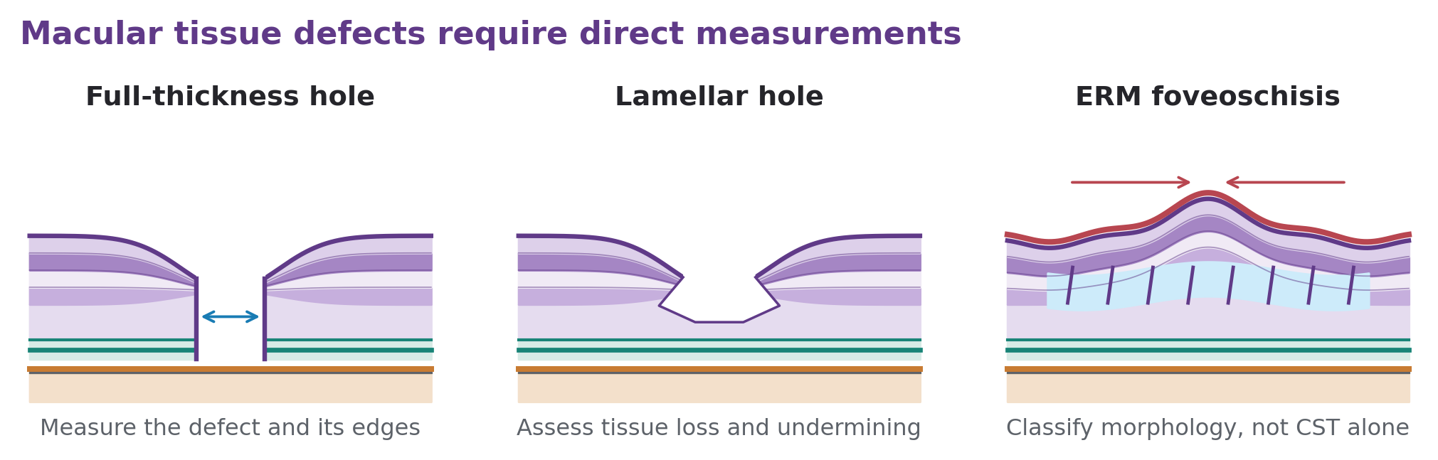 Schematic full-thickness hole, partial-thickness lamellar defect, and ERM-related distortion demonstrate why an average is insufficient.