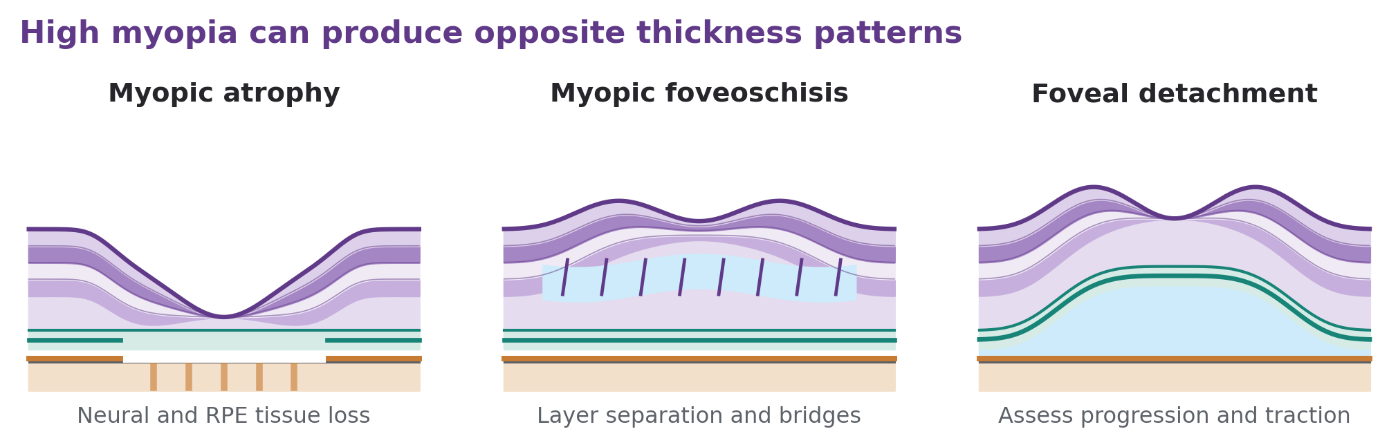 Three high-myopia-related patterns: atrophy, intraretinal splitting with bridging columns, and foveal detachment.