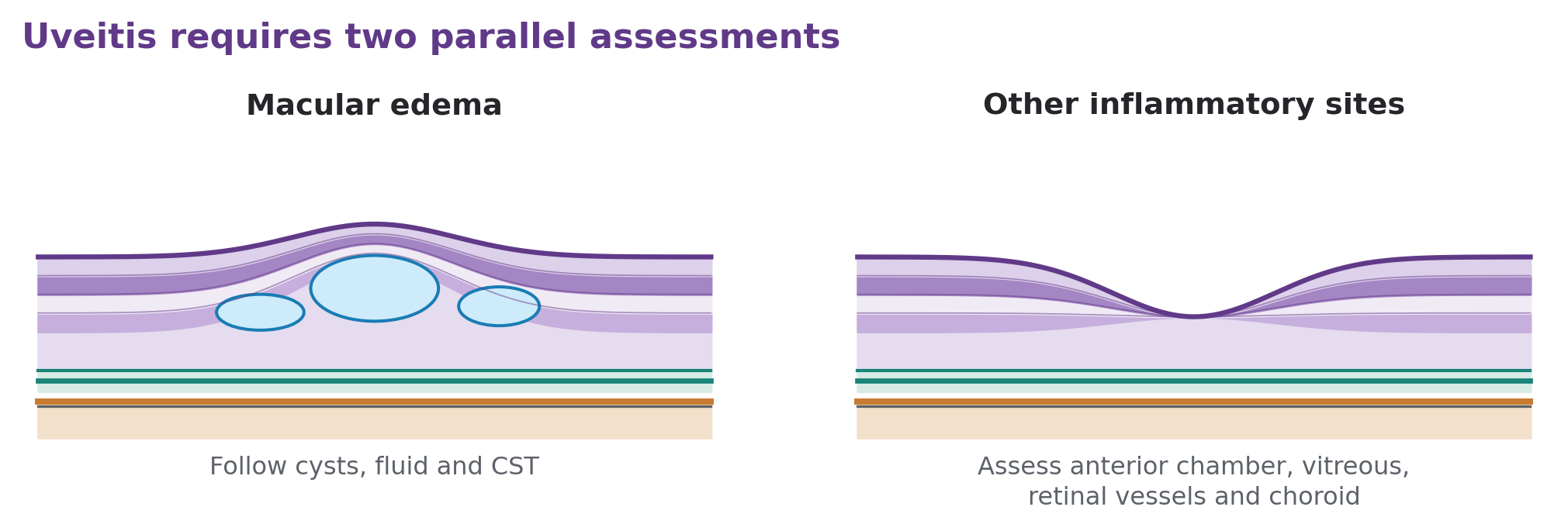 Cystoid macular edema beside a central section illustrating that macular thickness alone does not assess other sites of ocular inflammation.