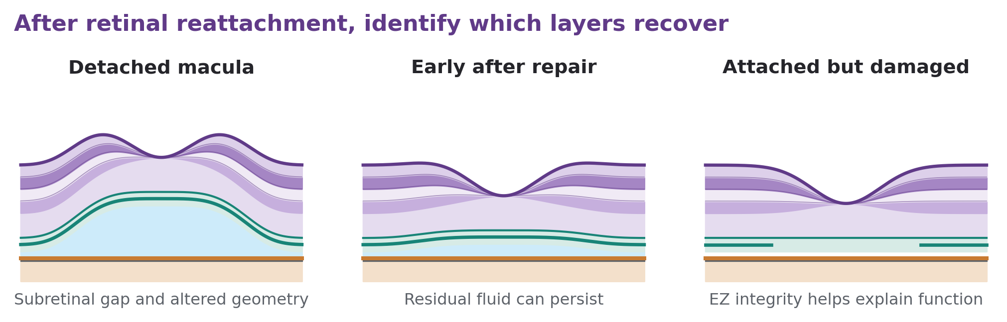 Three retinal sections show detachment, small residual subretinal fluid after reattachment, and an attached retina with residual EZ damage.