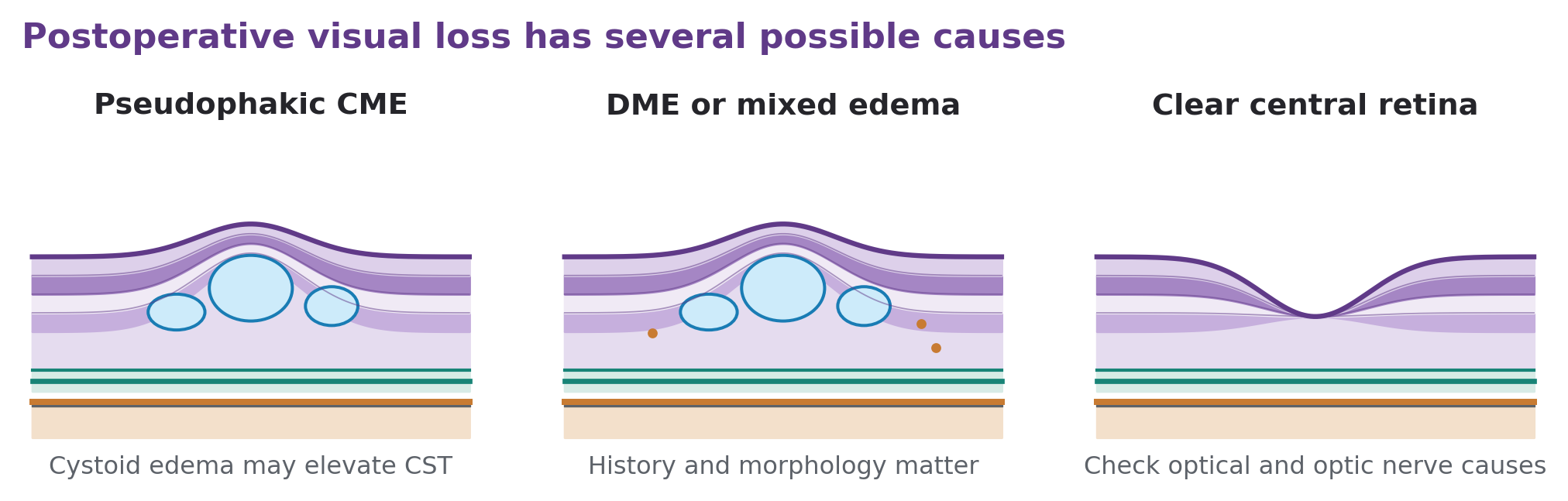 Panels compare postoperative cystoid edema, diabetic edema, and a structurally normal central retina in visual loss of another cause.