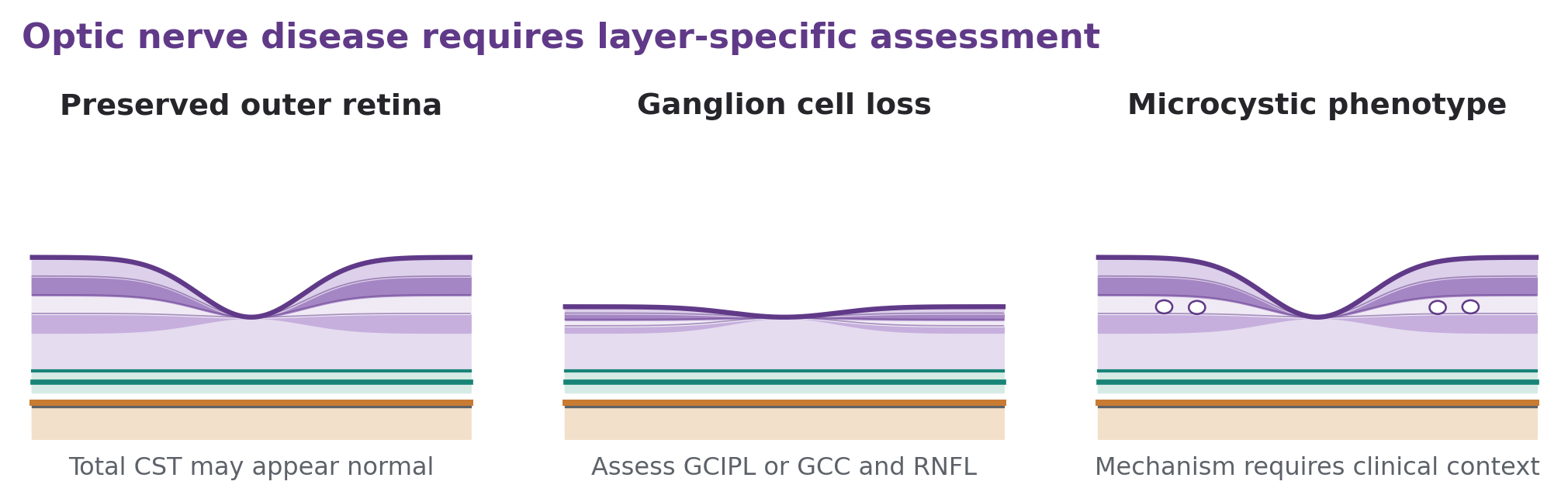 Normal and thinned inner retinal layers are compared with a schematic microcystic change to explain why CST does not stage optic neuropathy.