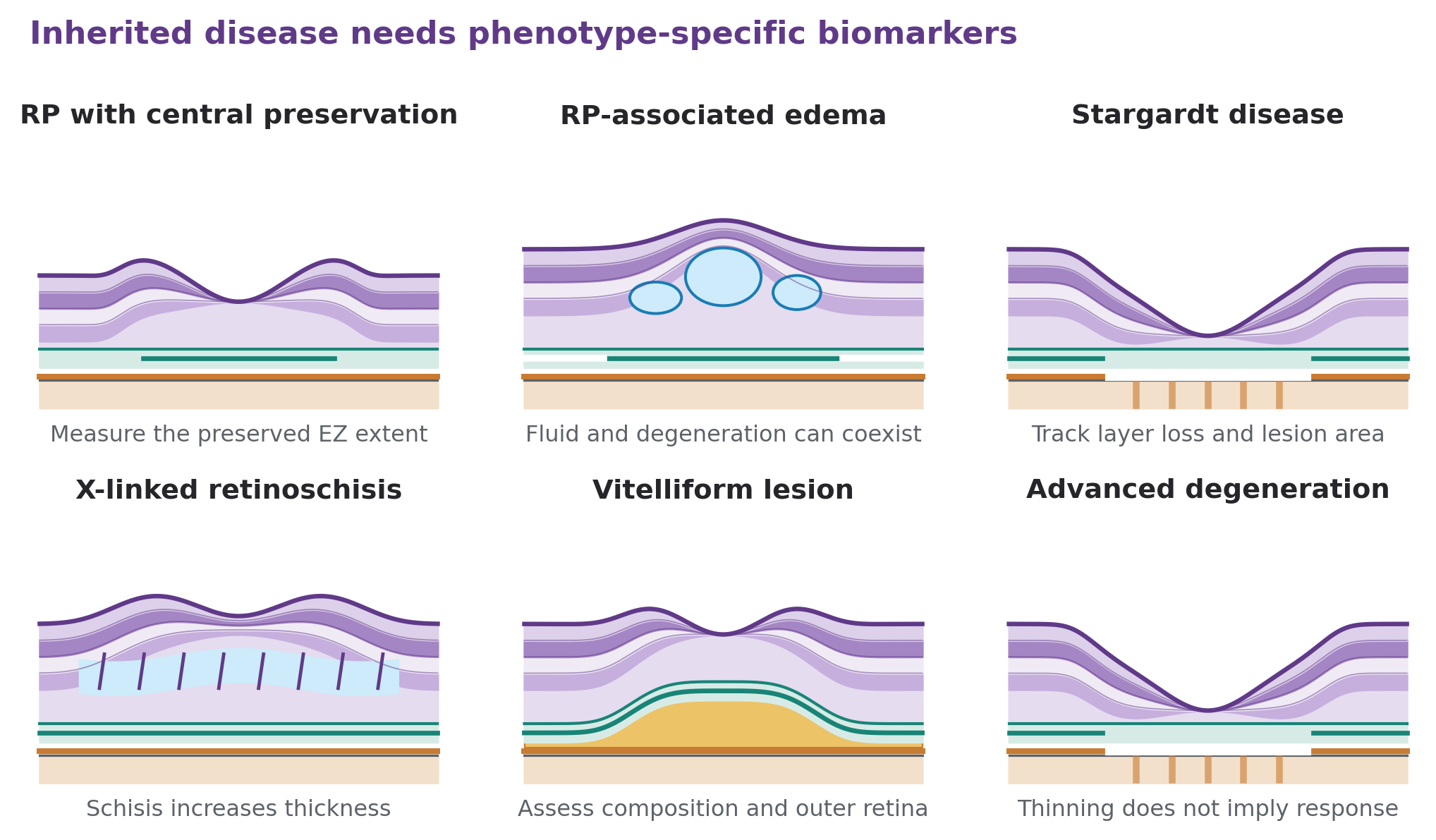 Six sketches cover preserved central EZ in RP, RP edema, Stargardt atrophy, X-linked schisis, vitelliform material, and advanced atrophy.