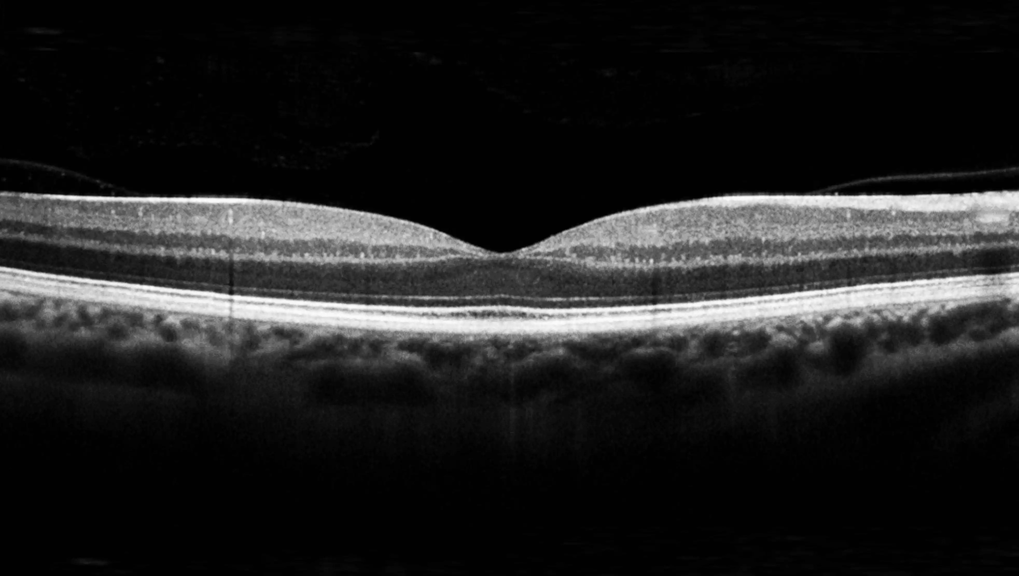 Central Subfield Thickness: Clinical Significance and Interpretation
