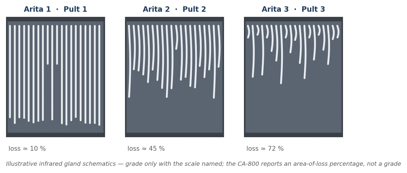 Figure 27 Schematic meibography at three loss levels with the Arita meiboscore and Pult five-grade scale. Grade only with the scale named; the CA-800 reports a percentage, not a grade. Illustrative.