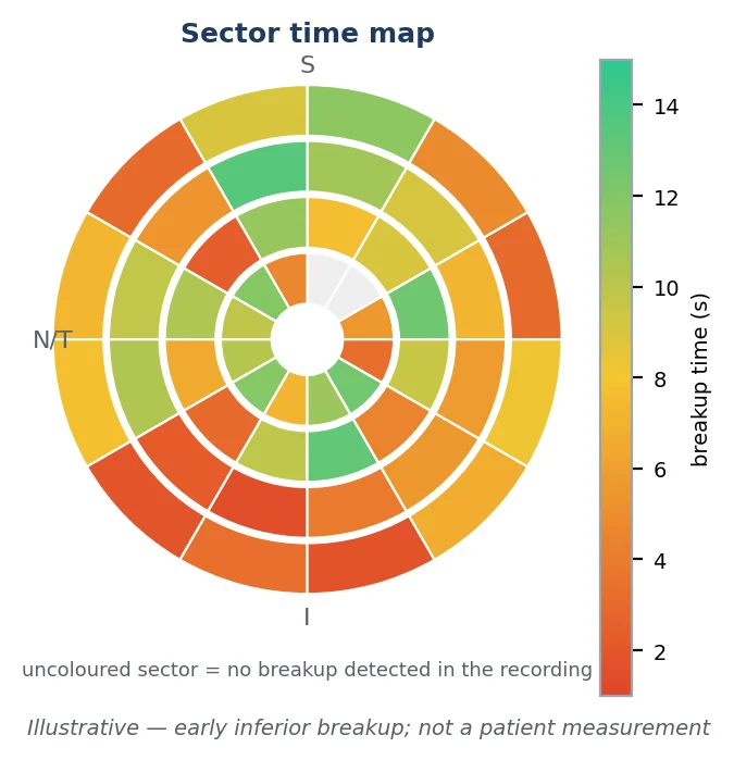 Figure 21 A sector time map with repeated early inferior breakup; uncoloured sectors had no breakup detected in the recording. Illustrative simulation.
