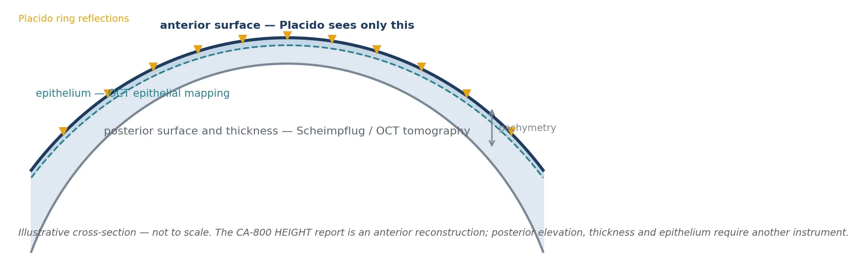 Figure 31 What each instrument class observes: Placido reflection reconstructs the anterior surface only; Scheimpflug tomography adds the posterior surface and pachymetry; anterior-segment OCT with Placido adds epithelial thickness. Illustrative cross-section, not to scale.