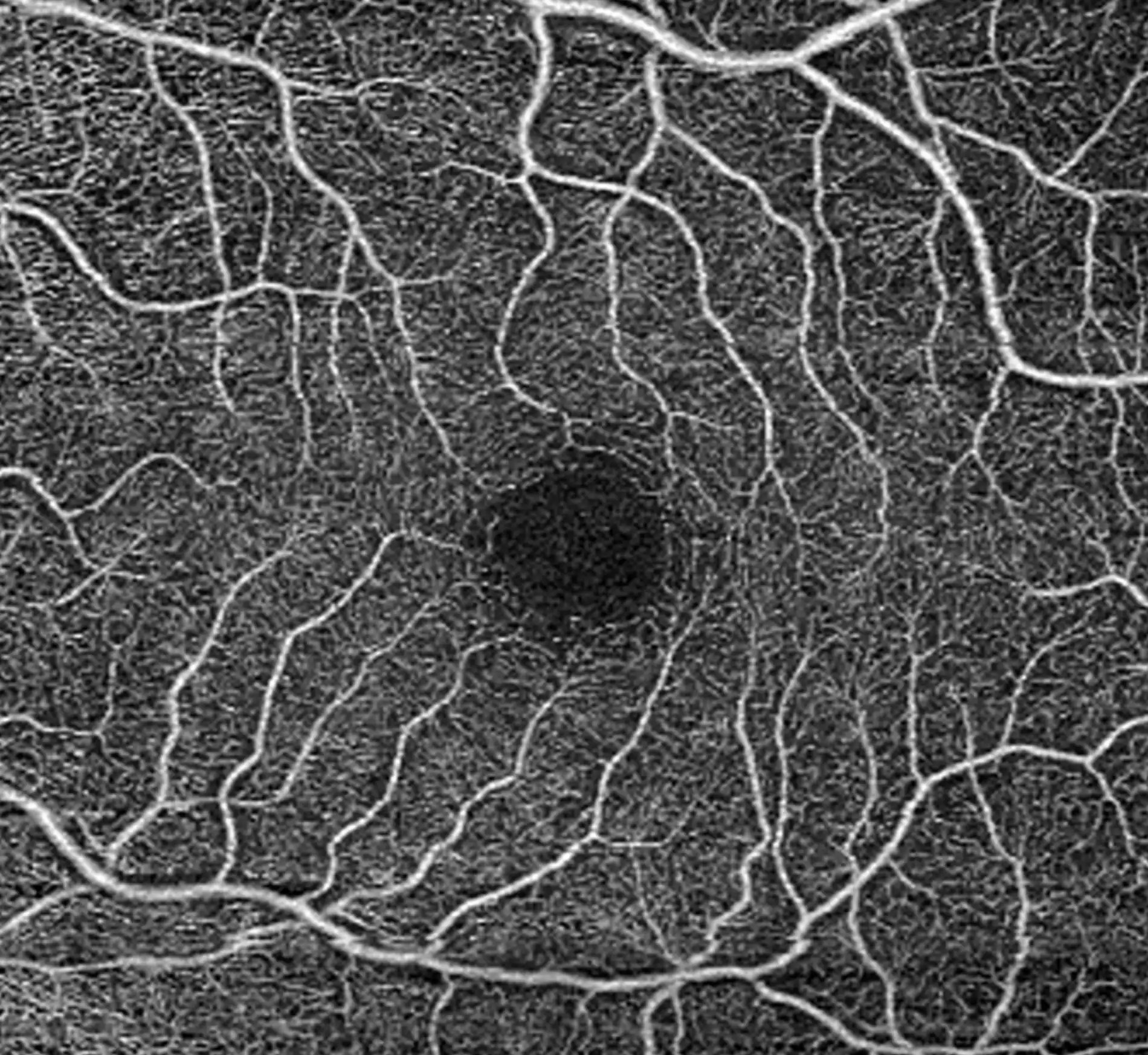 Researchers in the UK examined the possible vascular link between erectile dysfunction and primary open-angle glaucoma using two population-based primary care databases. Among more than one million men, ED had been recorded in 20% of POAG cases versus 17% of controls, and the odds of a glaucoma diagnosis were 17% to 29% higher in men with ED. Because ED medication is mostly taken on demand, the authors read the association as a sign of underlying vascular dysfunction rather than a drug effect. Shown: OCT angiography of the macular microvasculature.