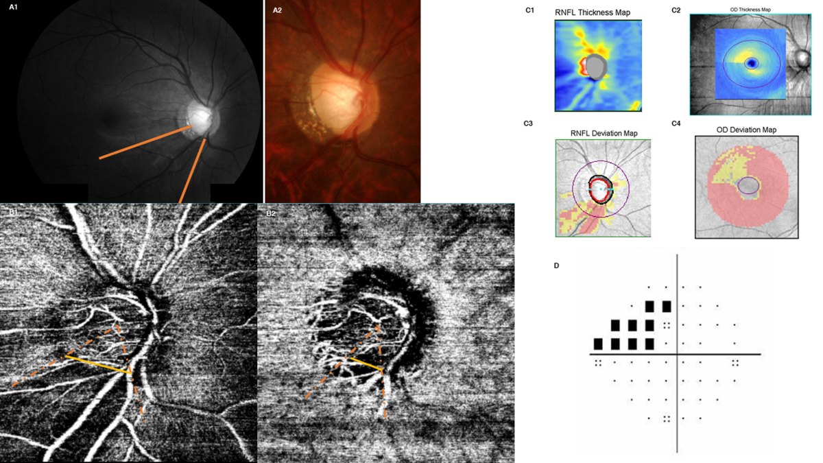 One eye with normal-tension glaucoma: red-free photograph with the inferotemporal nerve fibre layer defect bracketed, superficial and deep OCT angiography with dashed arrows marking the matching wedge of lost vessel density, RNFL thickness and deviation maps, optic disc maps, and a visual field plot with the corresponding superior arcuate defect.