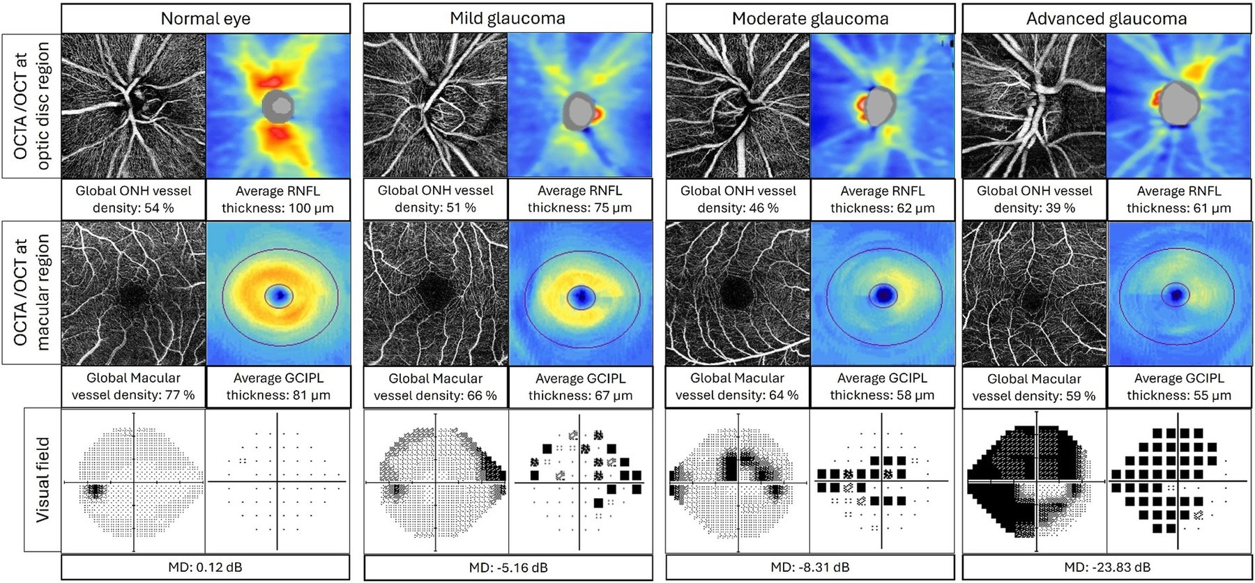 Four columns showing a normal eye and mild, moderate and advanced glaucoma: optic nerve head OCT angiography beside RNFL thickness maps, macular OCT angiography beside ganglion cell layer maps, and visual field greyscale and pattern deviation plots, with vessel density, thickness and mean deviation values.