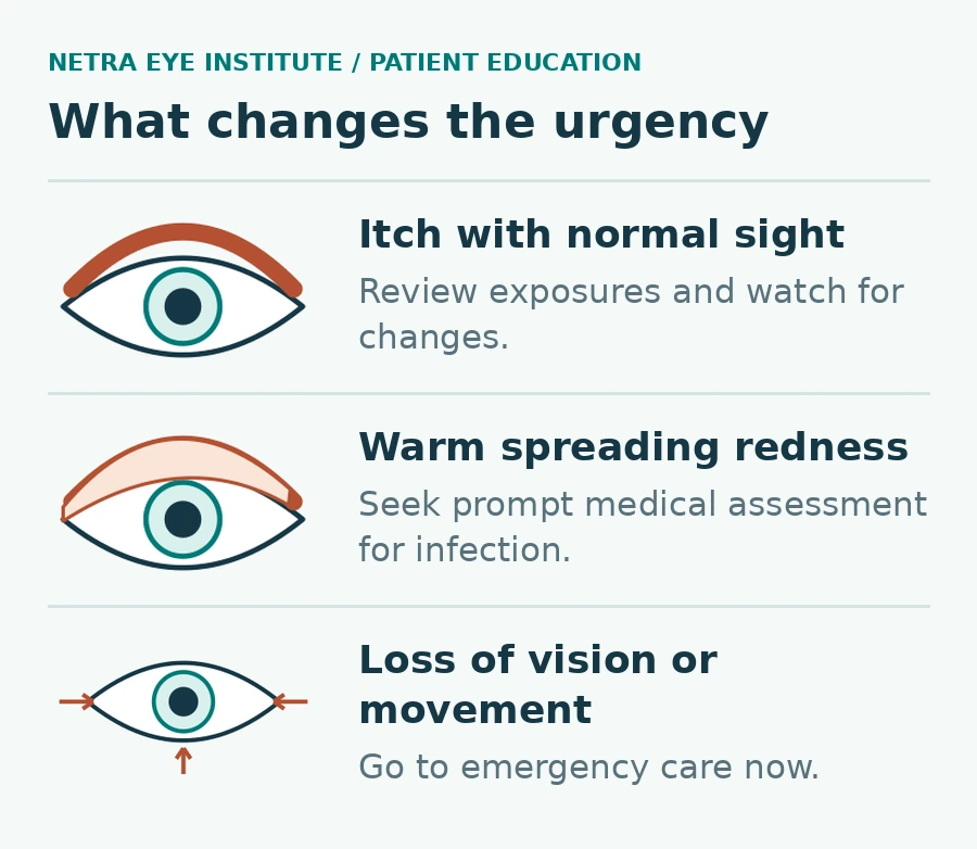 Netra Eye Institute patient education graphic titled 'What changes the urgency', showing three eye drawings side by side. Left, labeled 'Itch with normal sight': an eye with a thick orange band along the upper lid, with the text 'Review exposures and watch for changes.' Middle, labeled 'Warm spreading redness': an eye with a pale orange shaded, swollen upper lid, with the text 'Seek prompt medical assessment for infection.' Right, labeled 'Loss of vision or movement': an eye with orange arrows pointing inward from both corners and upward from below, with the text 'Go to emergency care now.'
