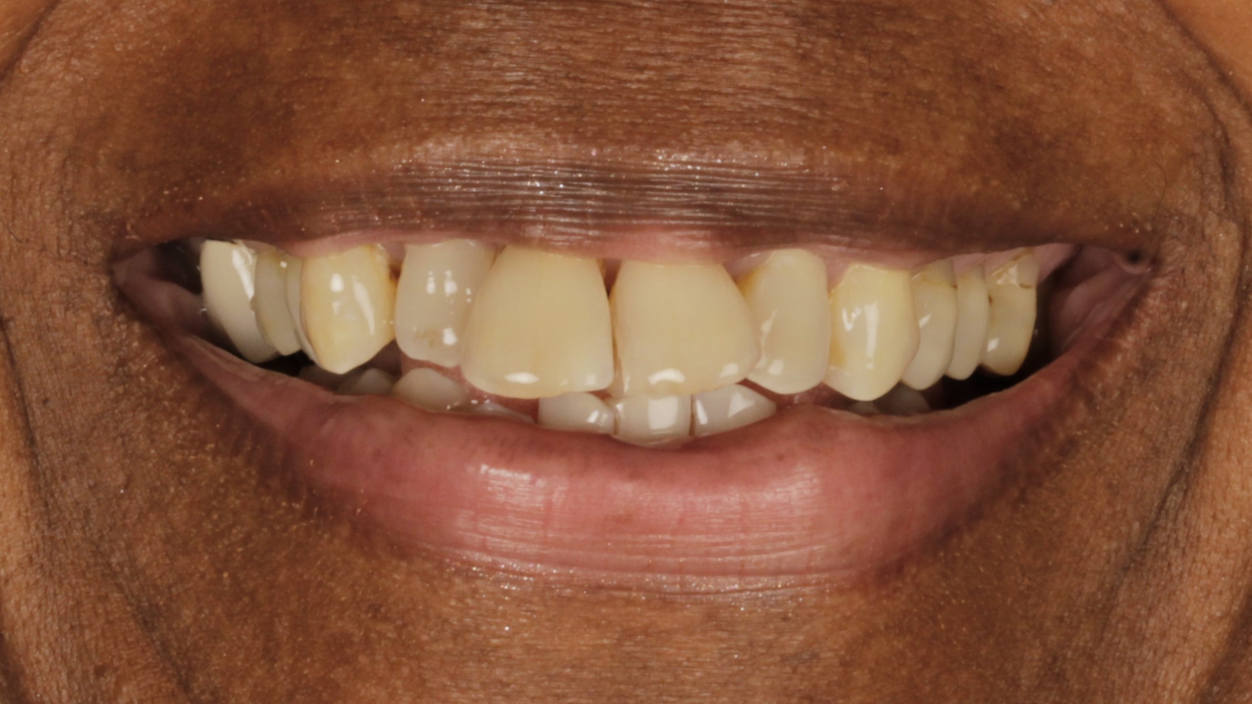 Patient smile before veneers and implant restoration