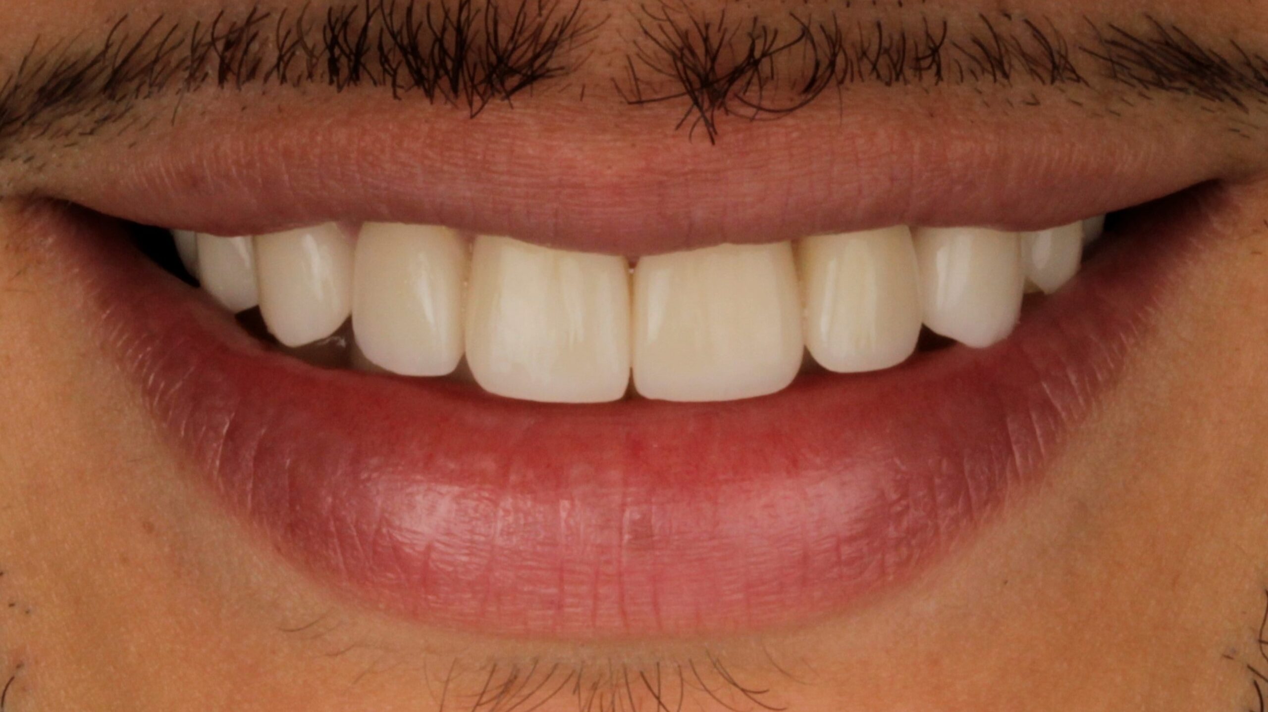 After: porcelain veneers