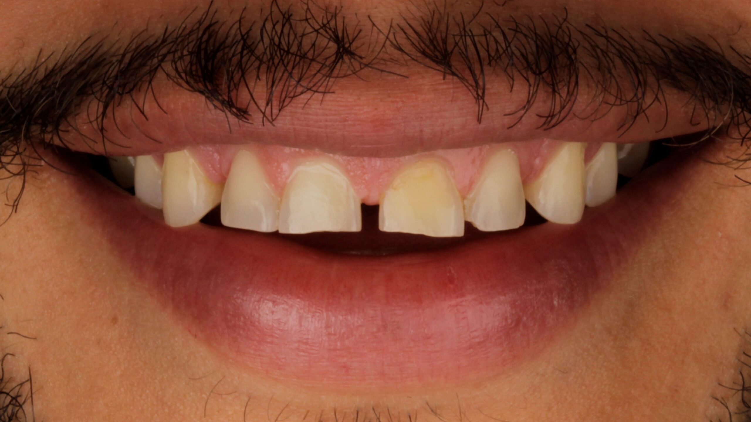 Before: worn and discoloured smile zone