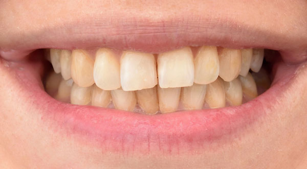 Before: discoloured teeth