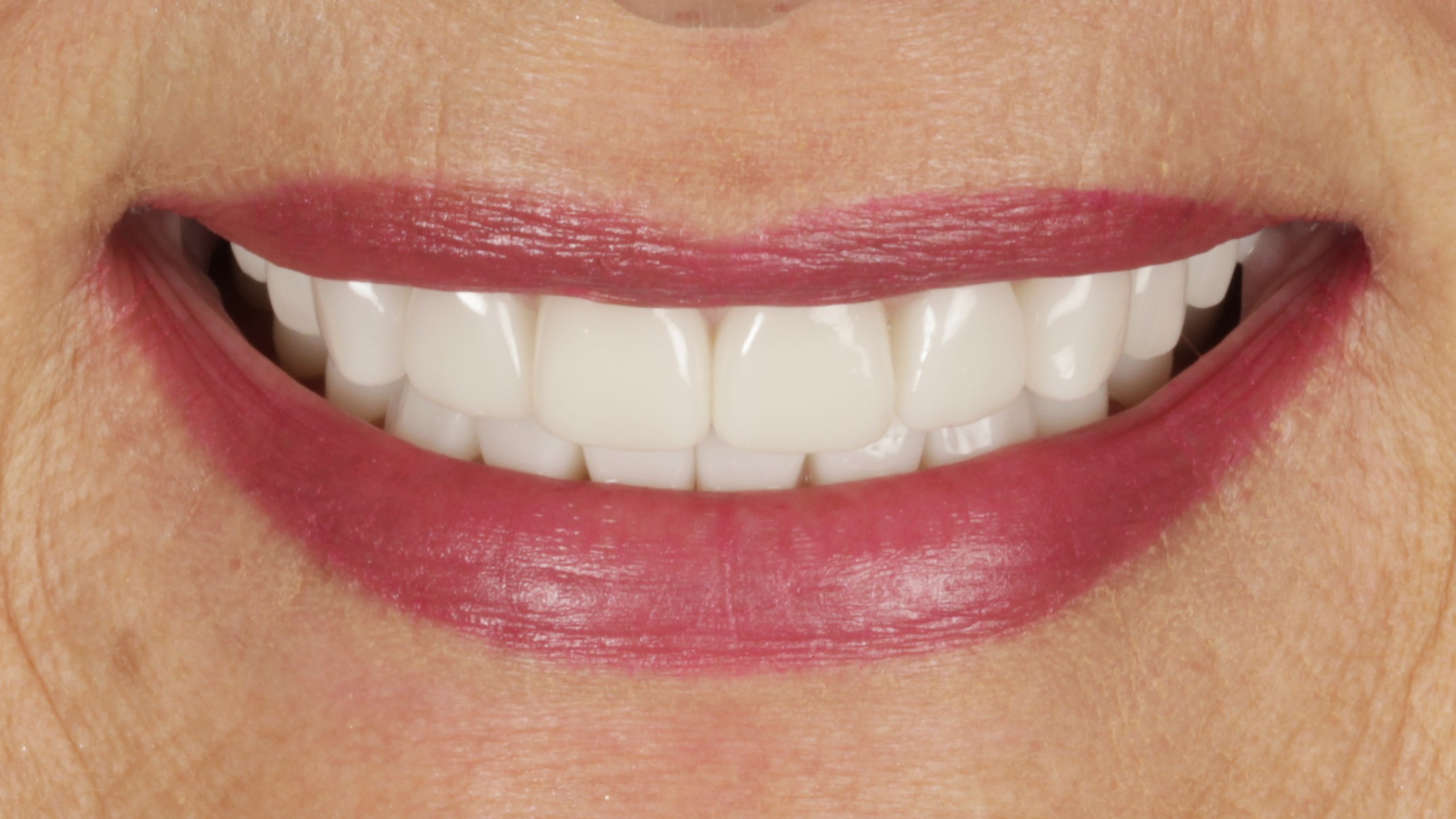 After: porcelain veneers