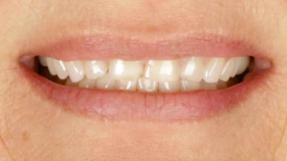 Before: chipped and worn front teeth