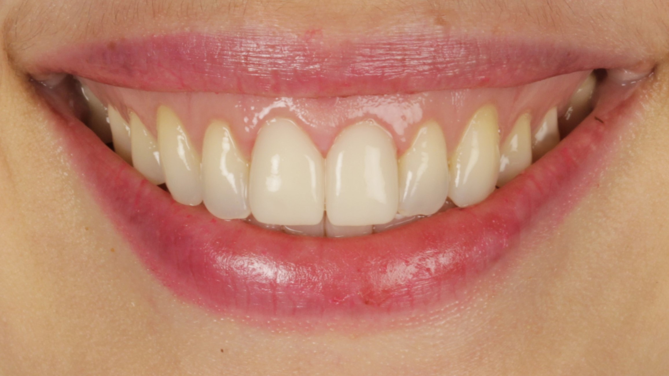 After: porcelain veneers