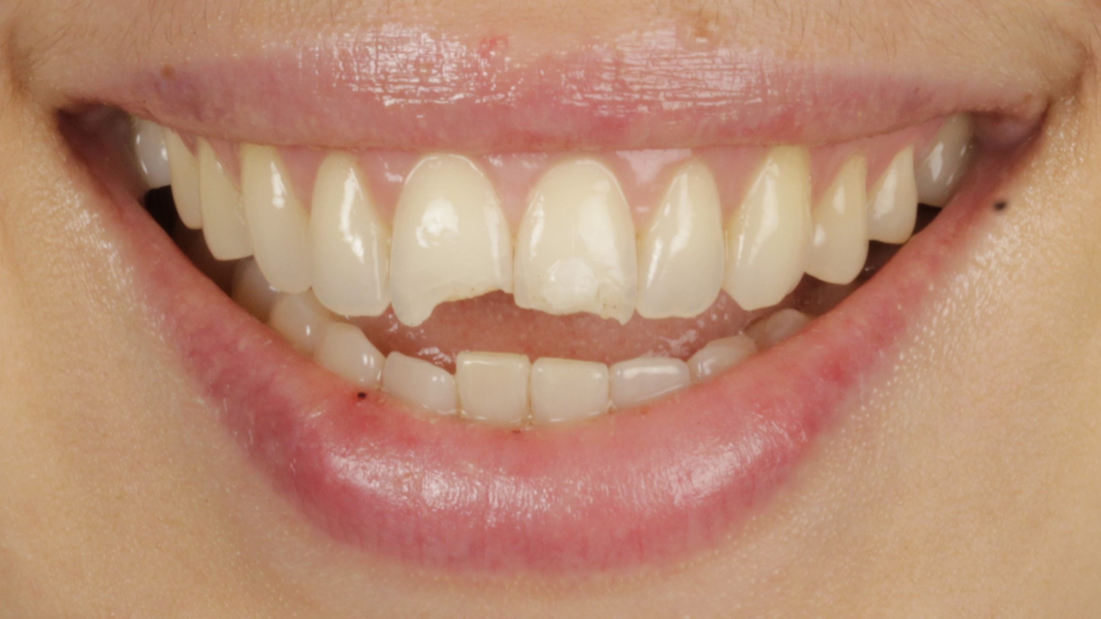 Before: discoloured and uneven teeth